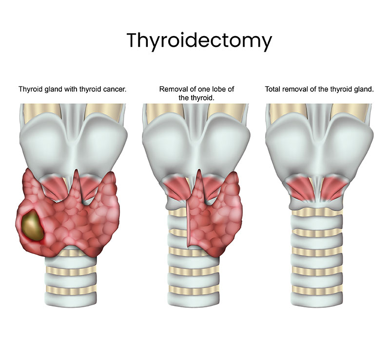 Thyroidectomy 3D graphic display