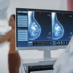 Pacijentkinja sa karcinomom dojke na mamogramu